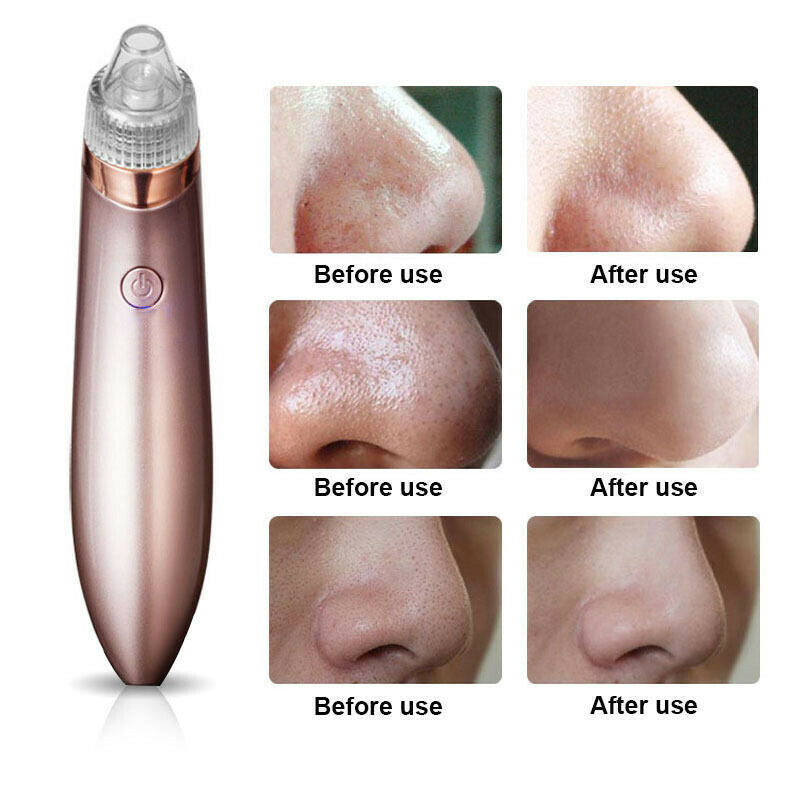 Electric Blackhead Vacuum – Pore & Acne Remover