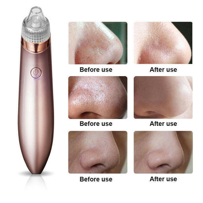 Electric Blackhead Vacuum – Pore & Acne Remover